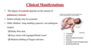 Clinical Manifestations
• The degree of cyanosis depends on the amount of
pulmonary stenosis.
• Infants initially may be acyanotic.
• Older children+ long standing cyanosis+ not undergone
surgery
 Dusky blue skin
 Grey sclera with engorged blood vessel
 Marked clubbing of fingers and toes
• Irritability
• Lethargic
• Reduced physical activity
• Fainting
• Clubbing of nails of fingers/toes
• Breathing difficulty
 
