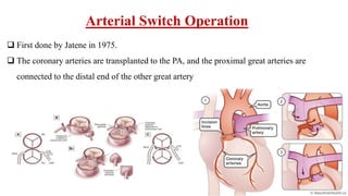 Arterial Switch Operation
 First done by Jatene in 1975.
 The coronary arteries are transplanted to the PA, and the proximal great arteries are
connected to the distal end of the other great artery
 
