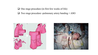  One stage procedure (in first few weeks of life)
 Two stage procedure -pulmonary artery banding + ASO
 