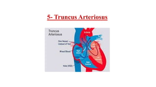 5- Truncus Arteriosus
 