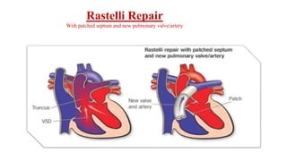 Rastelli Repair
With patched septum and new pulmonary valve/artery
 