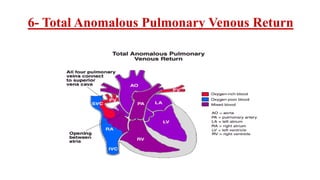 6- Total Anomalous Pulmonary Venous Return
 