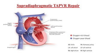 Supradiaphragmatic TAPVR Repair
 