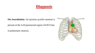 Diagnosis
On Auscultation- An ejection systolic murmur is
present at the Left parasternal region 3rd ICS due
to pulmonary stenosis.
 