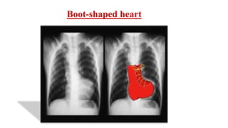 Boot-shaped heart
 
