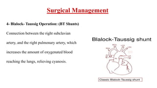 Surgical Management
4- Blalock- Taussig Operation: (BT Shunts)
Connection between the right subclavian
artery, and the right pulmonary artery, which
increases the amount of oxygenated blood
reaching the lungs, relieving cyanosis.
 