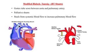 Modified Blalock- Taussig : (BT Shunts)
• Gortex tube sewn between aorta and pulmonary artery
• Palliative shunts
• Steals from systemic blood flow to increase pulmonary blood flow
 