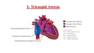 2- Tricuspid Atresia
 
