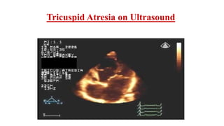 Tricuspid Atresia on Ultrasound
 