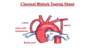 Classical Blalock Taussig Shunt
end to side
anastomosis
Rarely pref
 