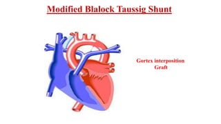 Modified Blalock Taussig Shunt
Gortex interposition
Graft
 