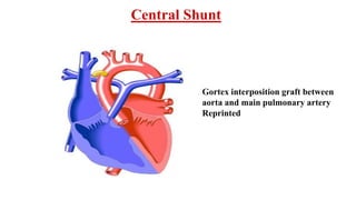 Central Shunt
Gortex interposition graft between
aorta and main pulmonary artery
Reprinted
 