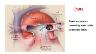 Direct anastomosis
descending aorta to left
pulmonary artery
Potts
 