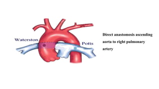 Direct anastomosis ascending
aorta to right pulmonary
artery
 