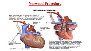 Norwood Procedure
 