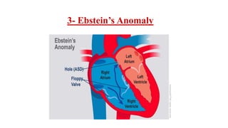 3- Ebstein’s Anomaly
 