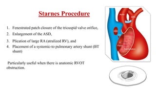 Starnes Procedure
1. Fenestrated patch closure of the tricuspid valve orifice,
2. Enlargement of the ASD,
3. Plication of large RA (atralized RV), and
4. Placement of a systemic-to pulmonary artery shunt (BT
shunt)
Particularly useful when there is anatomic RVOT
obstruction.
 