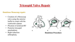 Tricuspid Valve Repair
Danielson Monocusp repair:
• Creation of a Monocusp
valve using the anterior
leaflet to coopt with the
ventricular septum.
• Plication of atralized RV
• Posterior tricuspid
annuloplasty
• Right reduction
arthroplasty.
Danielson Procedure
 