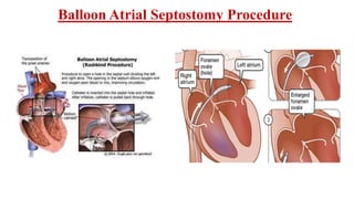 Balloon Atrial Septostomy Procedure
 