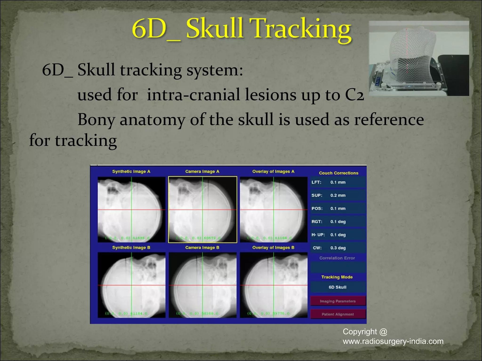 6D_ Skull tracking system:
used for intra-cranial lesions up to C2
Bony anatomy of the skull is used as reference
for tracking
Copyright @
www.radiosurgery-india.com
 