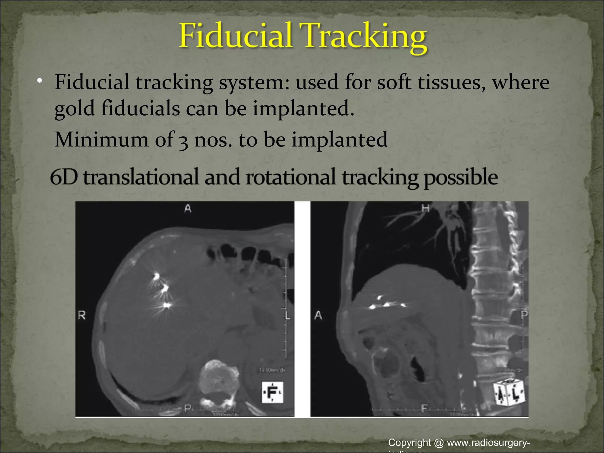 • Fiducial tracking system: used for soft tissues, where
gold fiducials can be implanted.
Minimum of 3 nos. to be implanted
Copyright @ www.radiosurgery-
 