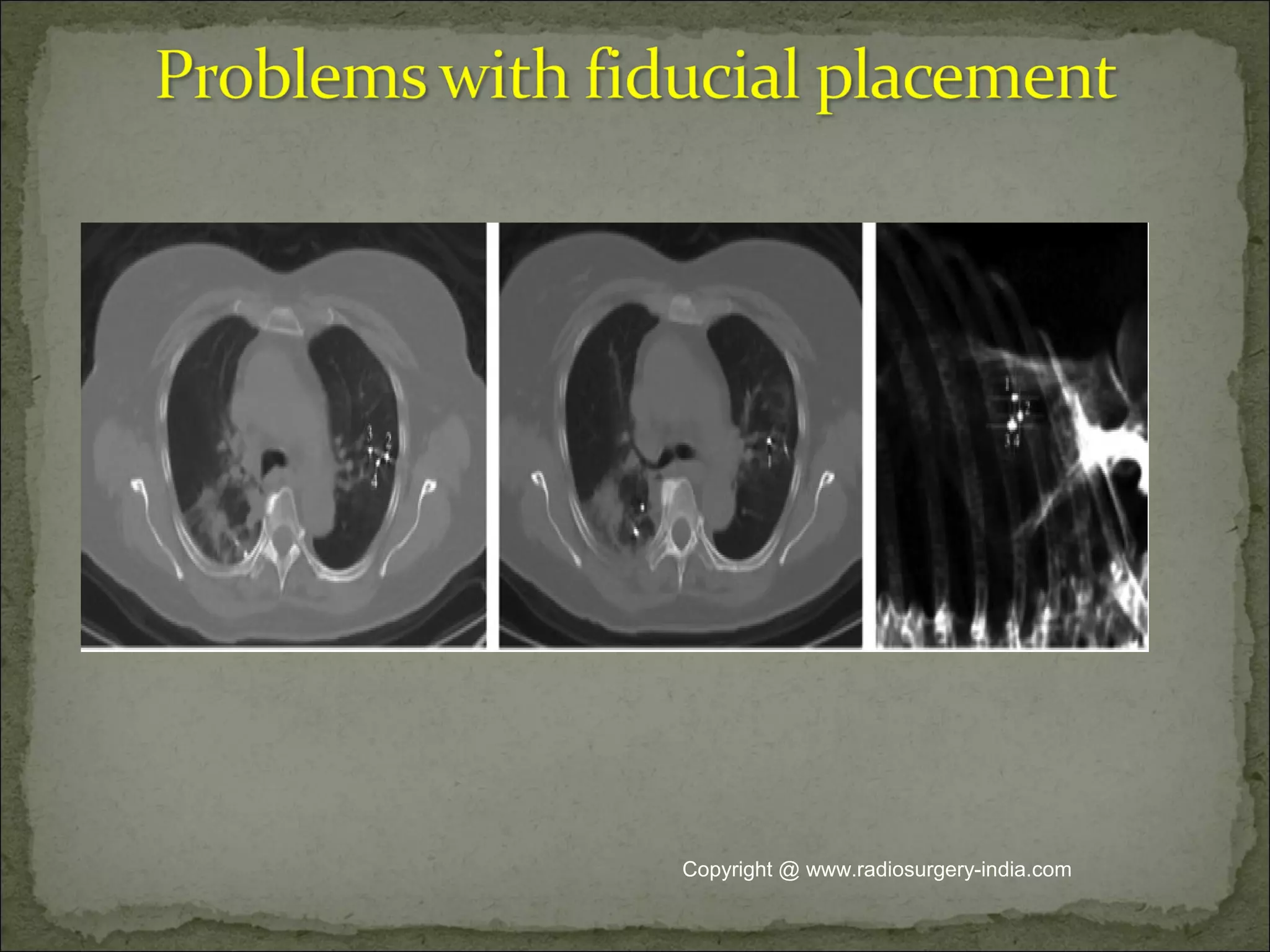 Copyright @ www.radiosurgery-india.com
 