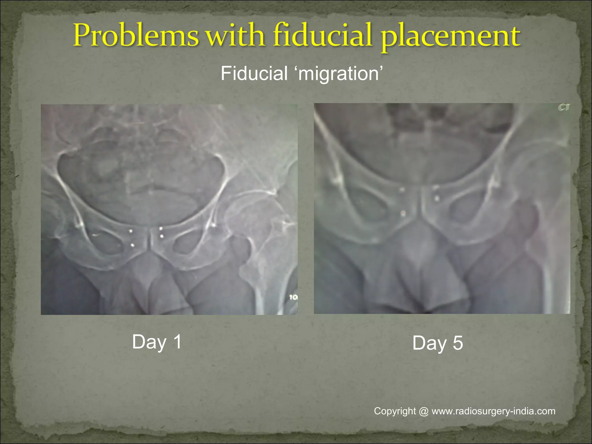 Day 1 Day 5
Fiducial ‘migration’
Copyright @ www.radiosurgery-india.com
 