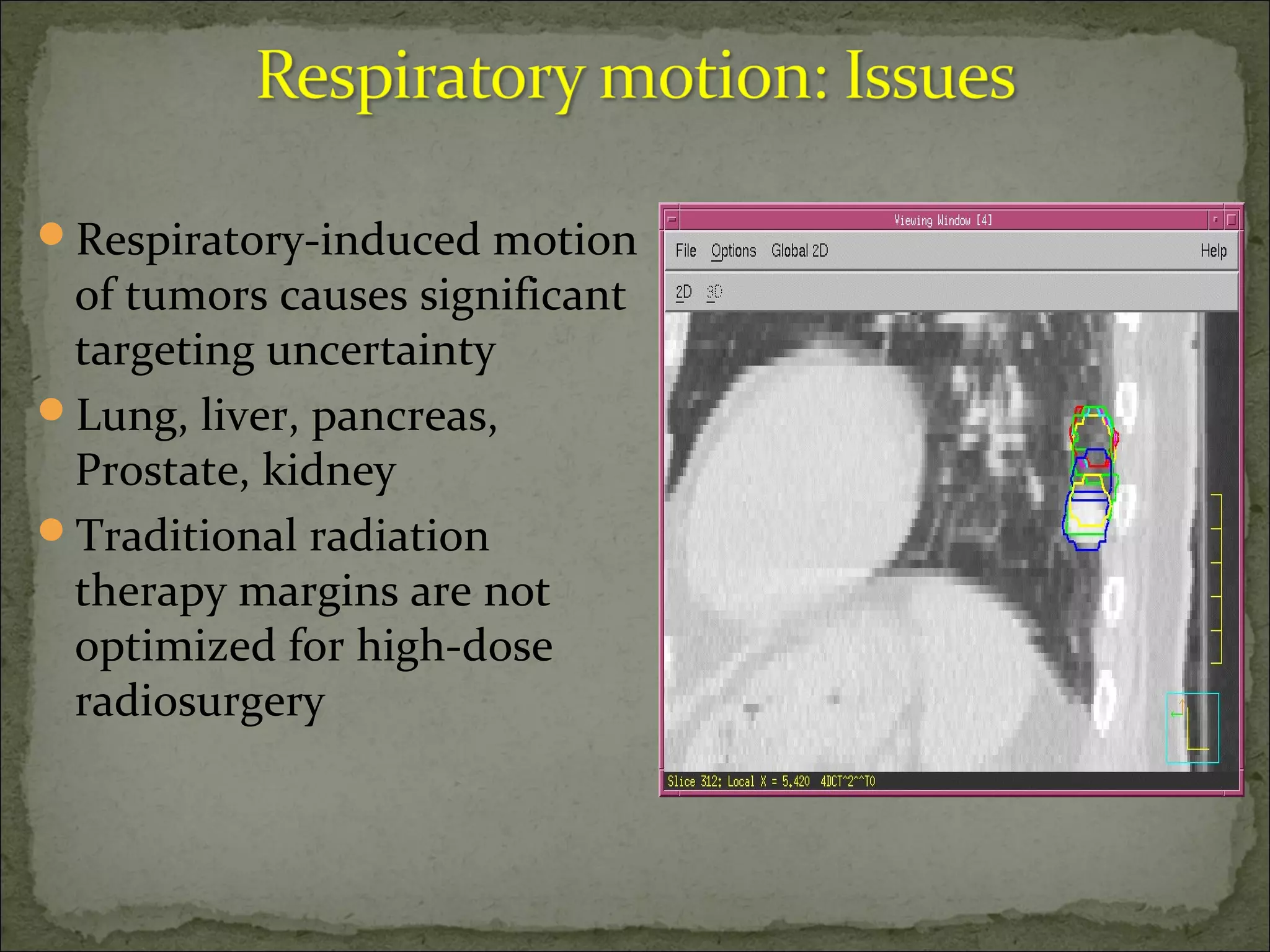Respiratory-induced motion
of tumors causes significant
targeting uncertainty
Lung, liver, pancreas,
Prostate, kidney
Traditional radiation
therapy margins are not
optimized for high-dose
radiosurgery
 