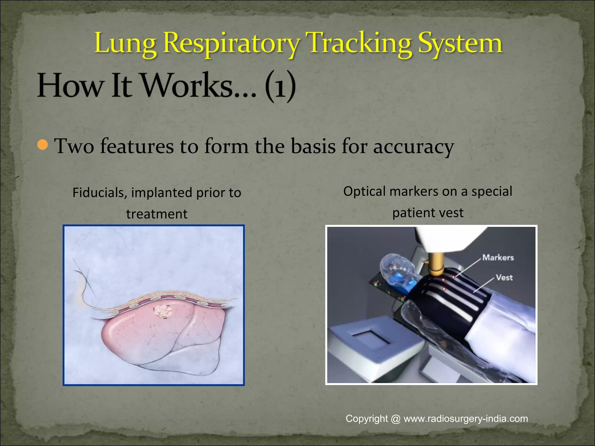 Two features to form the basis for accuracy
Fiducials, implanted prior to
treatment
Optical markers on a special
patient vest
Copyright @ www.radiosurgery-india.com
 