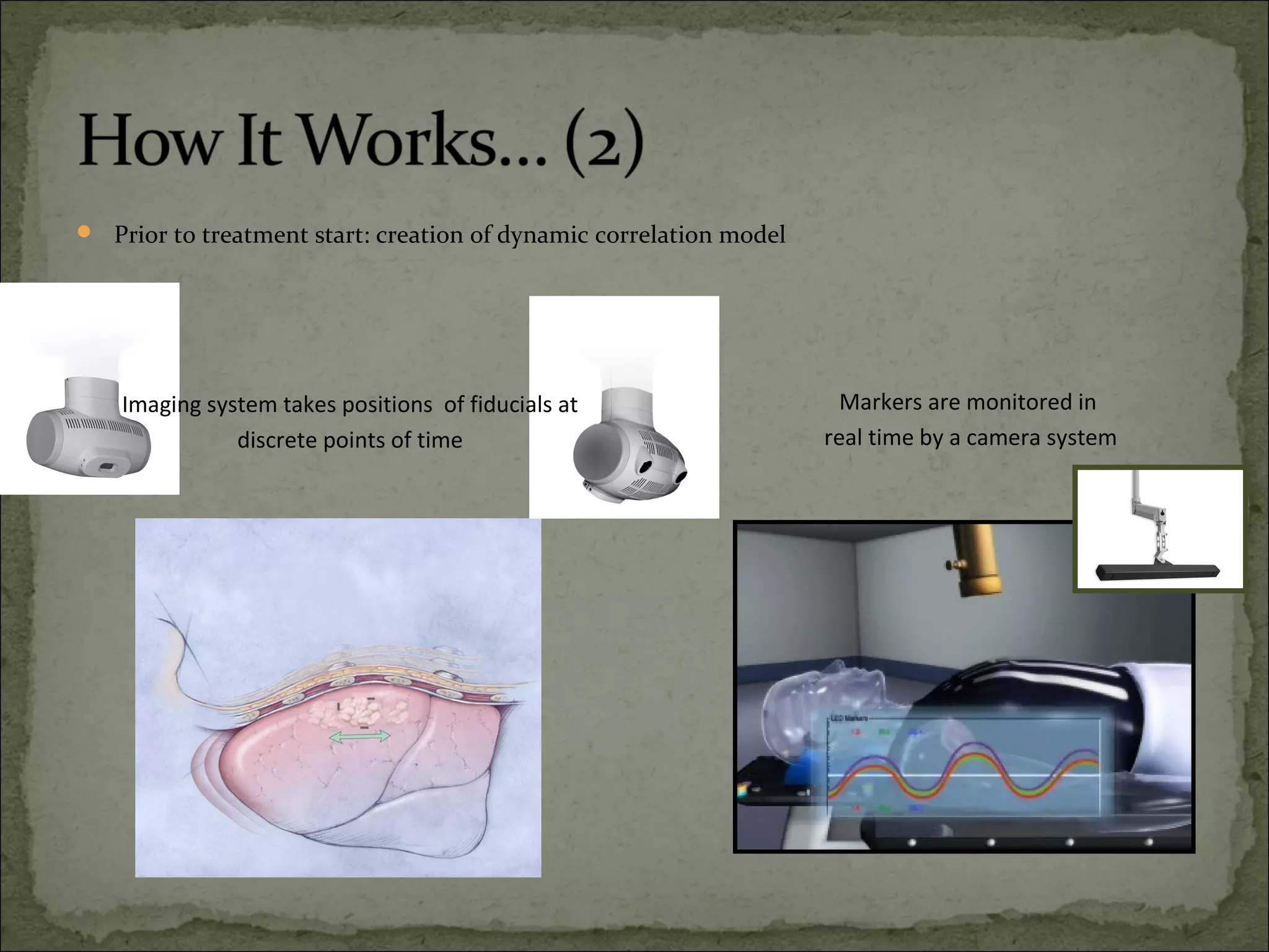  Prior to treatment start: creation of dynamic correlation model
Markers are monitored in
real time by a camera system
Imaging system takes positions of fiducials at
discrete points of time
 