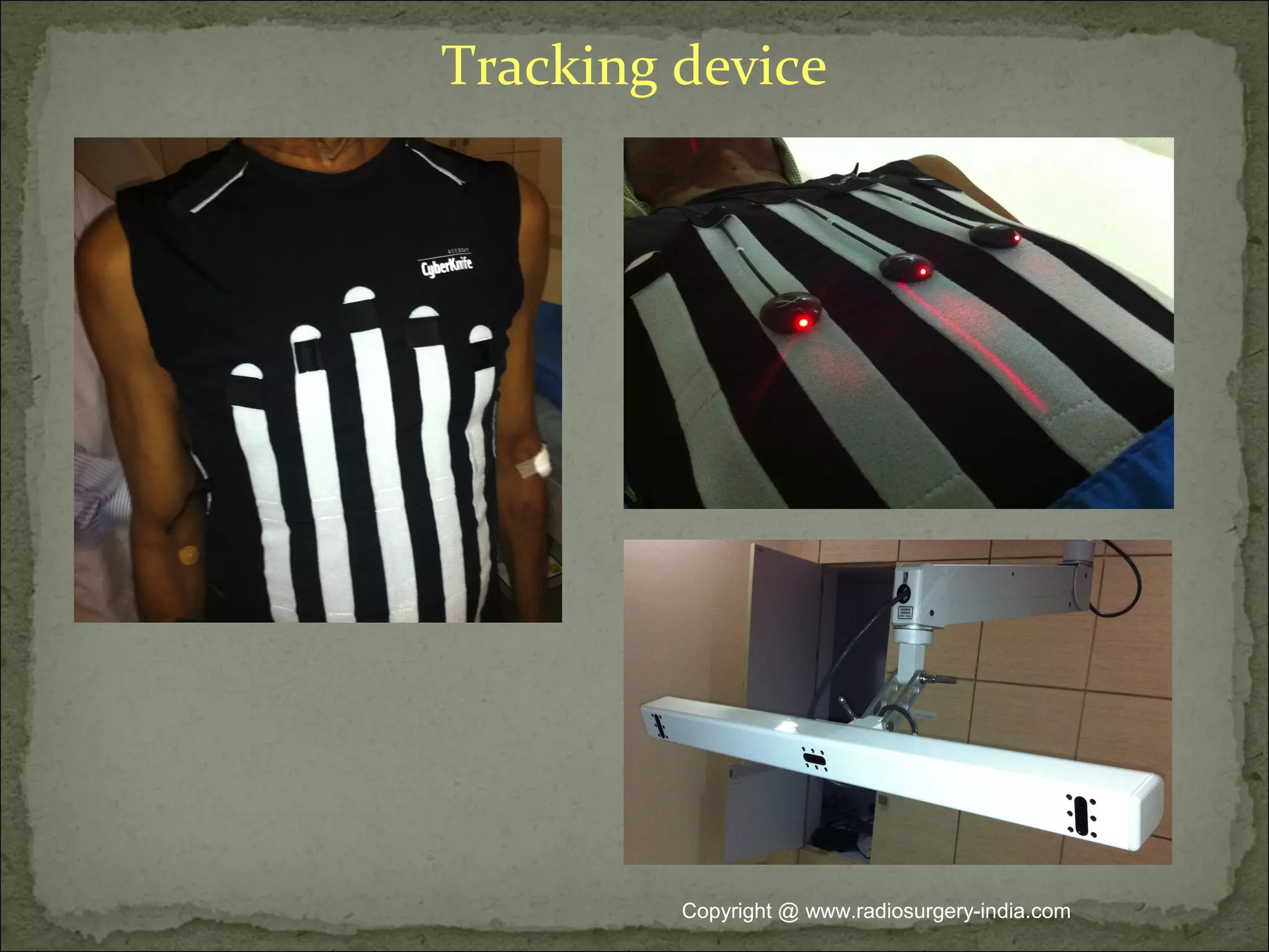 Tracking device
Copyright @ www.radiosurgery-india.com
 