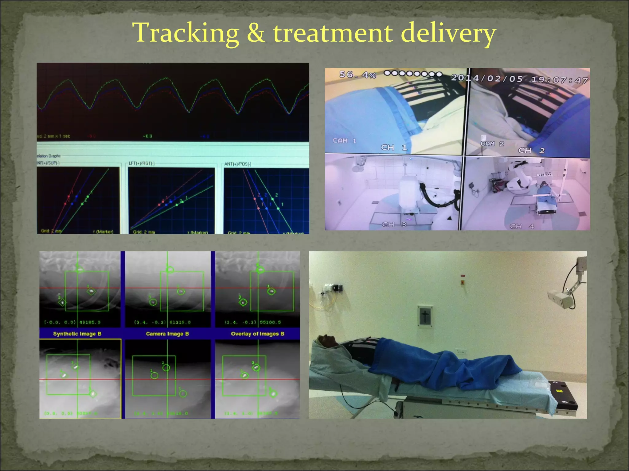 Tracking & treatment delivery
 