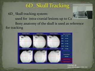 • Fiducial tracking system: used for soft tissues, where
gold fiducials can be implanted.
Minimum of 3 nos. to be implante...