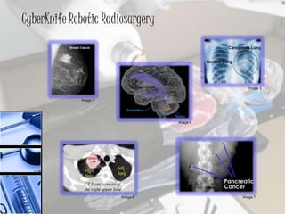 Cyber knife robotic radiosurgery system | PPTX