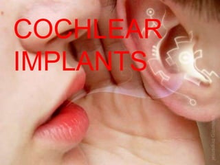 COCHLEAR
IMPLANTS
 
