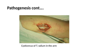 Pathogenesis cont….
Cysticercus of T. solium in the arm
 