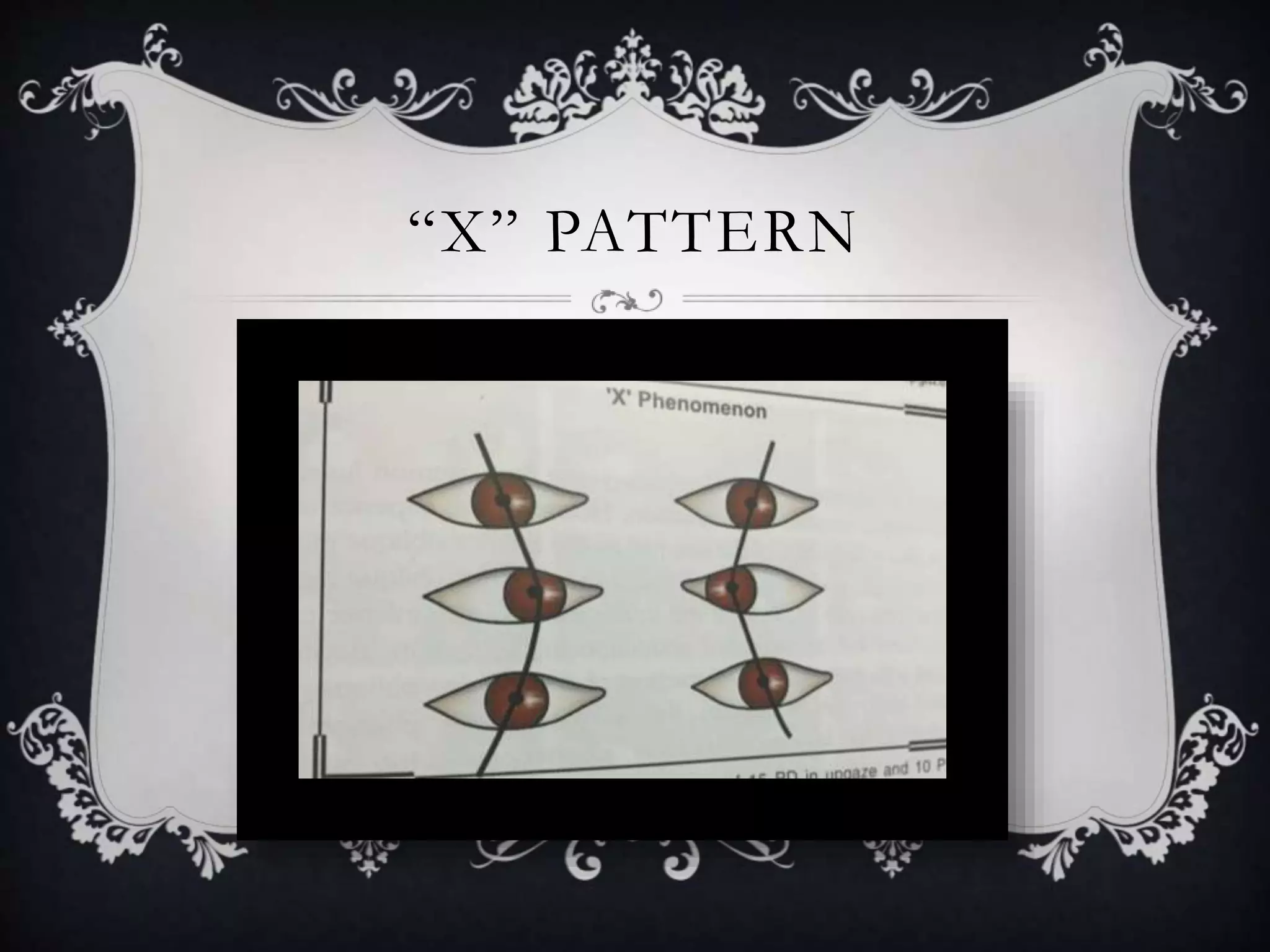 “X” PATTERN
 