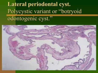 cycst of oral cavity pathology og llg cydydPT | PPT