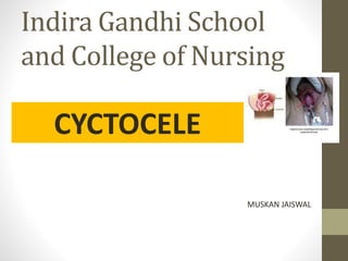 Indira Gandhi School
and College of Nursing
CYCTOCELE
MUSKAN JAISWAL
 