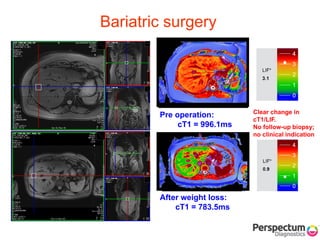 After weight loss:
cT1 = 783.5ms
Pre operation:
cT1 = 996.1ms
Clear change in
cT1/LIF.
No follow-up biopsy;
no clinical indication
Bariatric surgery
 