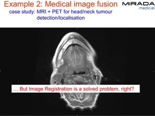 Example 2: Medical image fusion
case study: MRI + PET for head/neck tumour
detection/localisation
… But Image Registration is a solved problem, right?
 