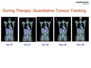 During Therapy: Quantitative Tumour Tracking
Apr 07 Oct 07 Apr 08 May 09 Nov 09
 
