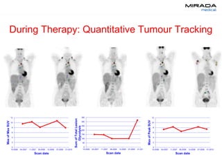 During Therapy: Quantitative Tumour Tracking
0
2
4
6
8
10
12
10-2006 04-2007 11-2007 06-2008 12-2008 07-2009 01-2010
MaxofMaxSUV
Scan date
0
50
100
150
200
250
300
350
10-2006 04-2007 11-2007 06-2008 12-2008 07-2009 01-2010
SumofTotalLesion
Glycolysis
Scan date
0
2
4
6
8
10
12
10-2006 04-2007 11-2007 06-2008 12-2008 07-2009 01-2010MaxofPeakSUV
Scan date
 