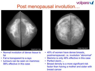 Post menopausal involution…
• Normal involution of dense tissue to
fat
• Fat is transparent to x-rays
• tumours can be seen on mammos:
98% effective in this case
• 40% of women have dense breasts,
postmenopausal, i.e. involution “abnormal”
• Mammo is only 48% effective in this case
• Perfect storm….
• Breast density is a more significant risk
factor than having a mother and sister with
breast cancer
 