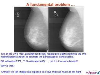 A fundamental problem …
Two of the UK’s most experienced breast radiologists each examined the two
mammograms shown, to estimate the percentage of dense tissue.
BK estimated 25%; TLS estimated 40% …. but it is the same breast!!!
Why is that?
Answer: the left image was exposed to x-rays twice as much as the right
 