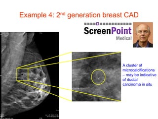 Example 4: 2nd generation breast CAD
A cluster of
microcalcifications
– may be indicative
of ductal
carcinoma in situ
 