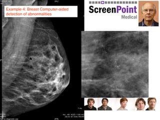 Example 4: Breast Computer-aided
detection of abnormalities
 