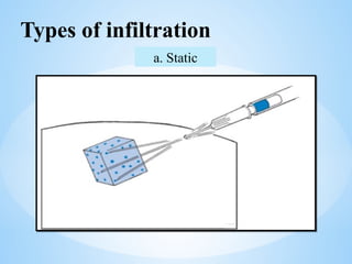 Types of infiltration
a. Static
 
