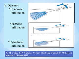 b. Dynamic
*Conewise
infiltration
*Fanwise
infiltration
*Cylindrical
infiltration
J H Cyriax & P J Cyriax. Cyriax's Illustrated Manual Of Orthopedic
Medicine, 2nd
Edition,1993.
 