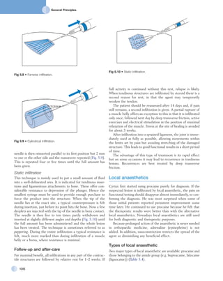 General Principles
106
full activity is continued without this rest, relapse is likely.
When tendinous structures are infiltrated by steroid there is a
second reason for rest, in that the agent may temporarily
weaken the tendon.
The patient should be reassessed after 14 days and, if pain
still remains, a second infiltration is given. A partial rupture of
a muscle belly offers an exception to this in that it is infiltrated
only once, followed next day by deep transverse friction, active
exercises and electrical stimulation in the position of maximal
relaxation of the muscle. Stress at the site of healing is avoided
for about 3 weeks.
After infiltration into a sprained ligament, the joint is imme-
diately used as fully as possible, allowing movements within
the limits set by pain but avoiding stretching of the damaged
structure. This leads to good functional results in a short period
of time.
The advantage of this type of treatment is its rapid effect
but on some occasions it may lead to recurrence in tendinous
lesions. Recurrences are best treated by deep transverse
friction.
Local anaesthetics
Cyriax first started using procaine purely for diagnosis. If the
suspected lesion is infiltrated by local anaesthetic, the pain on
functional testing should disappear almost immediately, so con-
firming the diagnosis. He was most surprised when some of
those initial patients reported persistent improvement some
time later. He continued to use procaine because he felt that
the therapeutic results were better than with the alternative
local anaesthetics. Nowadays local anaesthetics are still used
for both diagnostic and therapeutic purposes.
Because prolonged action of the anaesthetic is never needed
in orthopaedic medicine, adrenaline (epinephrine) is not
added. In addition, vasoconstriction restricts the spread of the
agent so diminishing any beneficial effect.
Types of local anaesthetic
Two major types of local anaesthetic are available: procaine and
those belonging to the amide group (e.g. bupivacaine, lidocaine
(lignocaine)) (Table 5.4).
needle is then reinserted parallel to its first position but 2 mm
to one or the other side and the manœuvre repeated (Fig. 5.9).
This is repeated four or five times until the full amount has
been given.
Static infiltration
This technique is mainly used to put a small amount of fluid
into a well-delineated area. It is indicated for tendinous inser-
tions and ligamentous attachments to bone. These offer con-
siderable resistance to depression of the plunger. Hence the
smallest syringe must be used to provide enough purchase to
force the product into the structure. When the tip of the
needle lies at the exact site, a typical counterpressure is felt
during insertion, just before its point hits the bone. Now a few
droplets are injected with the tip of the needle in bony contact.
The needle is then five to ten times partly withdrawn and
inserted at slightly different angles and depths (Fig. 5.10) until
the full amount has been administered and the whole lesion
has been treated. The technique is sometimes referred to as
peppering. During the entire infiltration a typical resistance is
felt, much more marked than during infiltration of a muscle
belly or a bursa, where resistance is minimal.
Follow-up and after-care
For maximal benefit, all infiltrations in any part of the contrac-
tile structures are followed by relative rest for 1–2 weeks. If
Fig 5.8 • Fanwise infiltration.
Fig 5.9 • Cylindrical infiltration.
Fig 5.10 • Static infiltration.
 